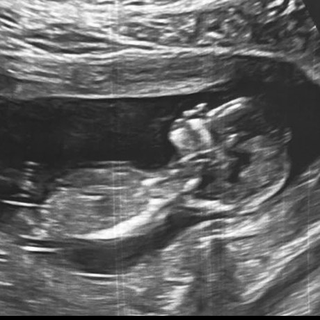 Ultrasound of Baby Zukauskas